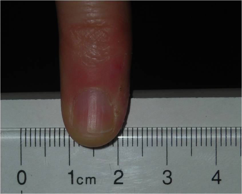image of pinky finger